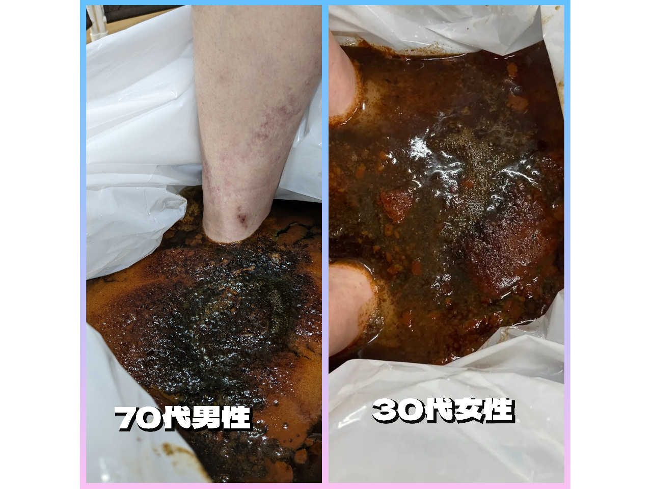 抗がん剤治療中の70代男性と30代女性。各4回目・3回目の状態。泡・色・等には意味があるんですよ。