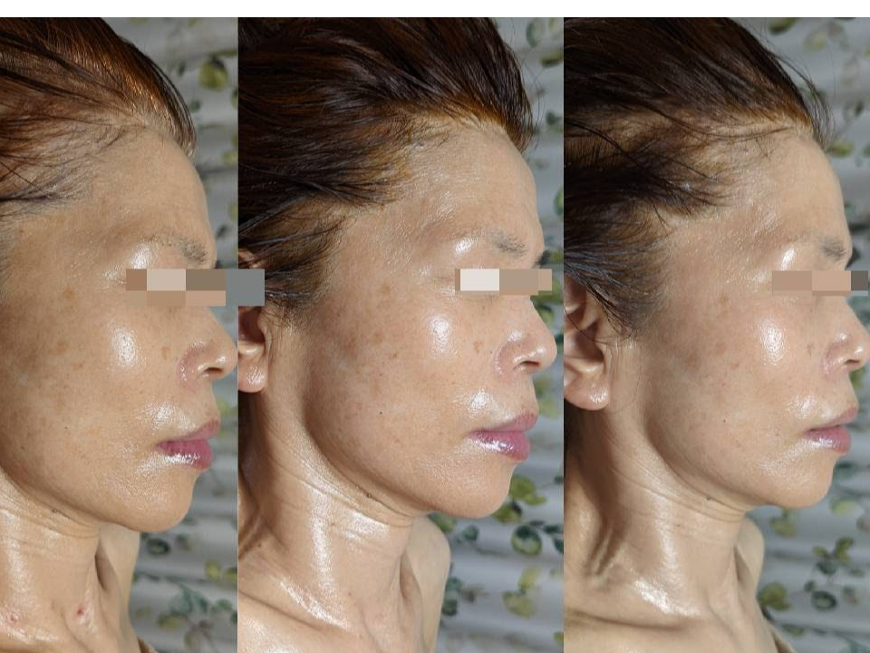 ���ʎʐ^���@������before�@���A�Eafter